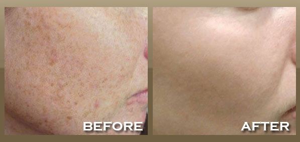 Intense Pulsed Light Laser Treatment - American Skin Institute