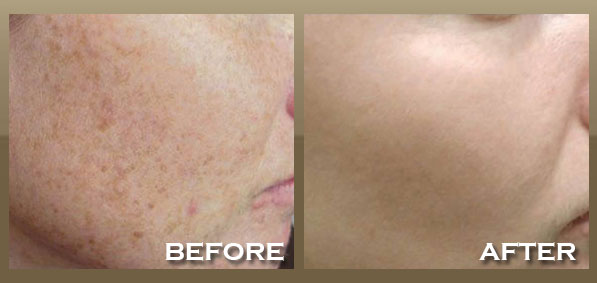 Laser Treatment | Intense Pulsed Light (IPL)