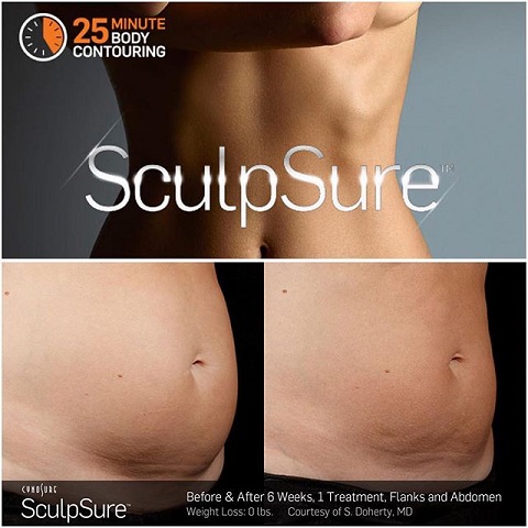 sculpsure-2.jpg